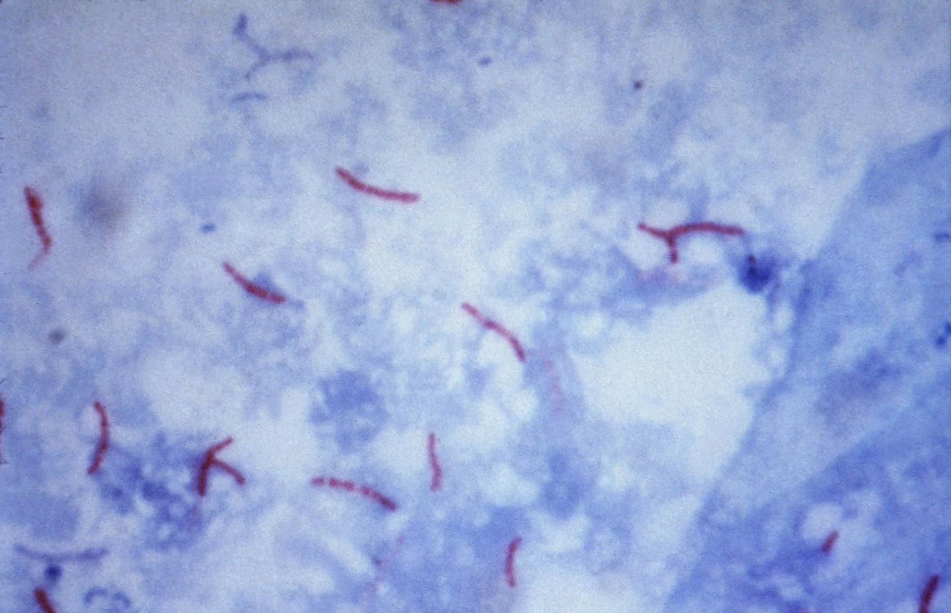 1920px-mycobacterium_tuberculosis_ziehl-neelsen_stain_02.webp